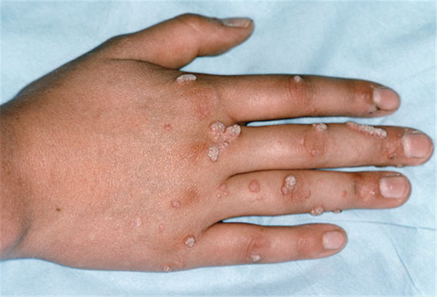 <b>5. Mụn cóc/mụn cơm (Warts)</b><br/>Hiện nay bệnh do một loại virus gây ra nhưng thường là vô hại, u da không đau. Mụn cóc có thể lây dễ dàng từ người này sang người khác. Bệnh có thể lây qua tiếp xúc với đồ vật được sử dụng bởi người mang virus. Virus thường được tìm thấy ở các ngón tay và bàn tay. Để ngăn ngừa mụn cóc lây lan, hãy nhắc trẻ không cậy hoặc cắn móng tay… Hình ảnh: Tổn thương mụn cóc/mụn cơm trên da