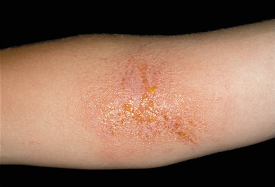<b>7. Viêm da tiếp xúc (Contact Dermatitis)</b><br/>Da của một số trẻ em phản ứng sau khi chạm vào thực phẩm, xà phòng, hoặc thực vật như cây thường xuân (poison ivy), cây thù du (sumac), hoặc gỗ sồi. Ban thường bắt đầu trong vòng 48 giờ sau khi tiếp xúc với da. Các trường hợp nhẹ có thể gây đỏ nhẹ hoặc phát ban da gà nhỏ mầu đỏ. Trong trường hợp nặng, bạn có thể thấy sưng nề, đỏ, và mụn nước lớn hơn. Ban này biến mất sau một hoặc hai tuần hoặc khi tiếp xúc kết thúc. Hình ảnh: Tổn thương viêm da do tiếp xúc